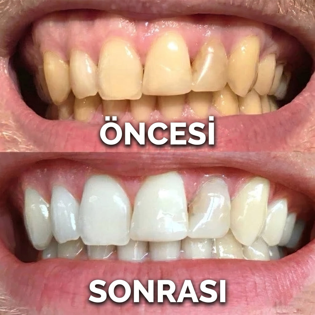 Diş Beyazlatma Jeli | Hızlı Diş Beyazlatıcı