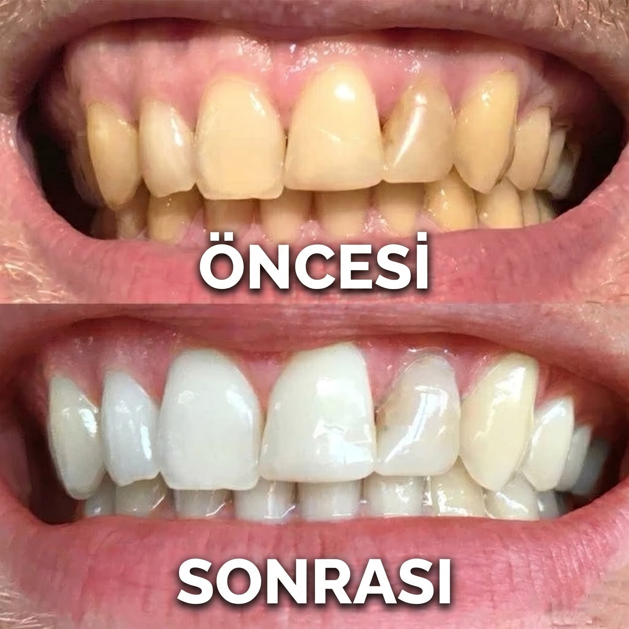 Diş Beyazlatma Jeli | Hızlı Diş Beyazlatıcı